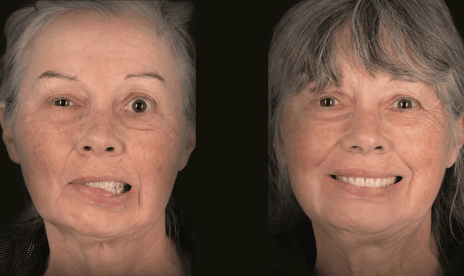 Before and after photos of a patient treated for severe facial synkinesis with a dual-vector gracilis muscle transfer by Dr. Nate Jowett