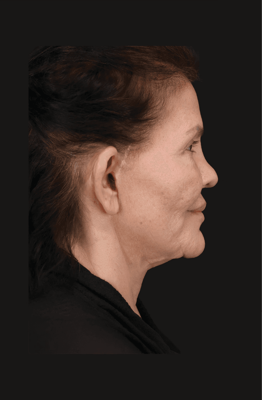 Secondary Facelift - Before - Right lateral