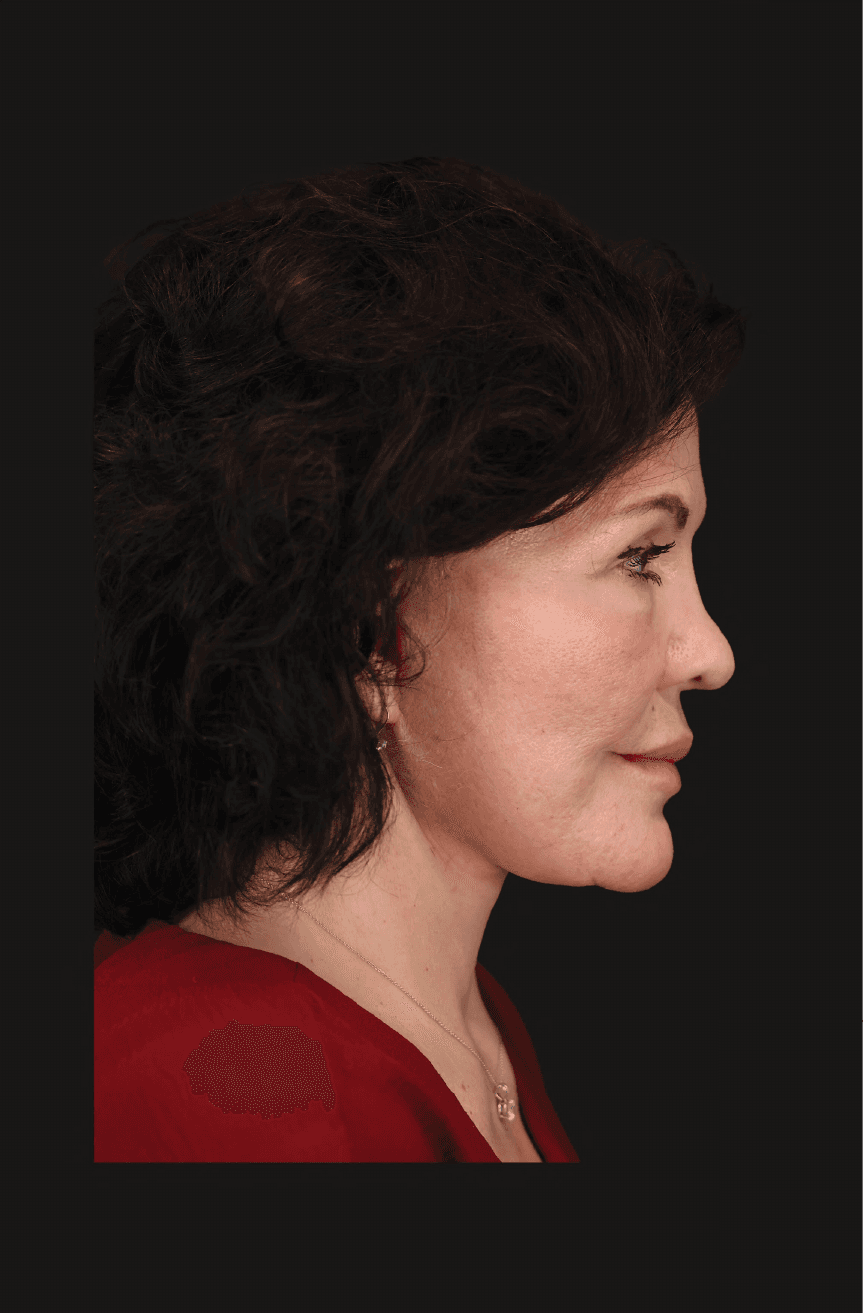 Secondary Facelift - After - Right lateral