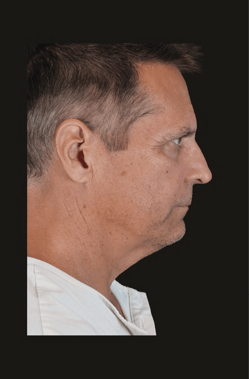 Primary Structural Neck Lift - Before - Right lateral