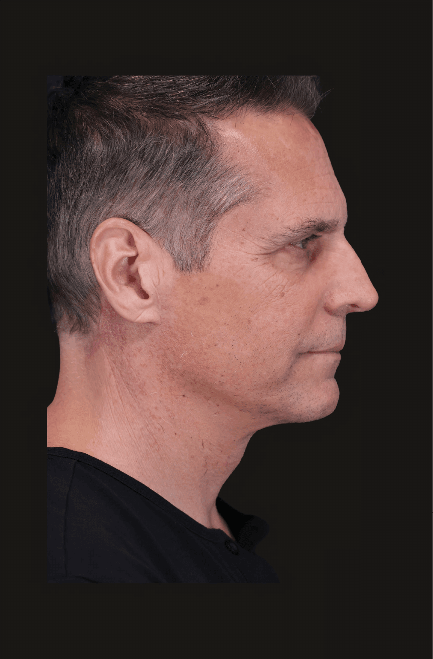Primary Structural Neck Lift - After - Right lateral